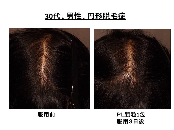 円形脱毛症　病院""
